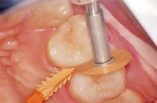 ポストウェッジというべきか、隣接面の研磨は、ウェッジを挿入してわずかに歯間離開させてから行うのがポイント（上顎左側第1、2小臼歯間隣接面を研磨している）