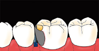 頰舌側のエナメル質については、マトリックスバンドを装着する前に少し広めに行うことがポイント。
