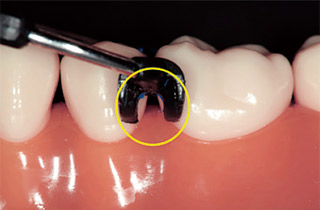 コンポジタイト3Dリテーナーを装着後、黄色丸部分にウェッジを挿入する