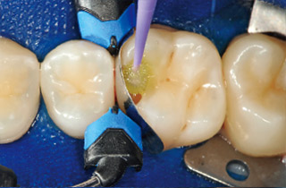 う蝕除去後、接着操作を行う。
