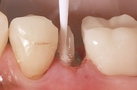 歯質の部分にティースプライマーを塗布。出血させないように注意する。