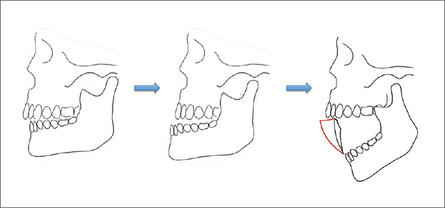 新型開口訓練器により誘導される顎運動と顎関節運動の図