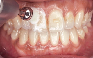 歯に付いているアタッチメントなどを気にせずにAPペーストを塗布できる。