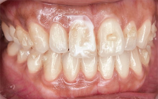 痛みはすぐに消え、程良い粘稠度のため施術中も液だれの心配がなく塗布後も歯面に残っている。