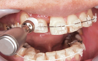 配列直後の動揺があるような歯でもAPペースト塗布時の痛みはない。