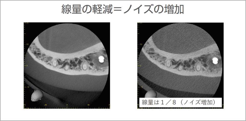 線量を低減するとノイズが増加する。診断の妨げにならない範囲で、線量を低減する