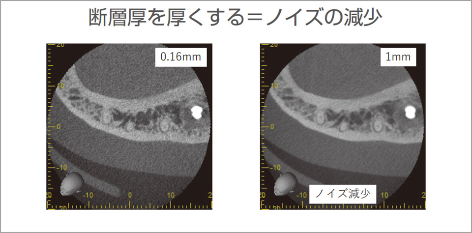 線量が少なくノイズが多い画像では断層厚を厚くするとノイズが低減される