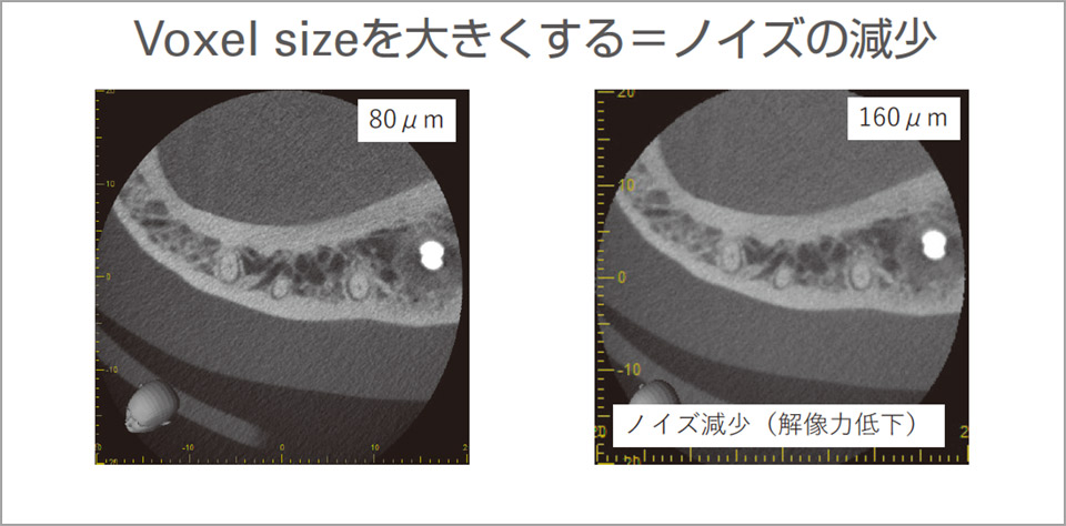 X800では撮影後にノイズが多い場合では、再々構成で大きなVoxel sizeを選択することで、ノイズを抑制できる。