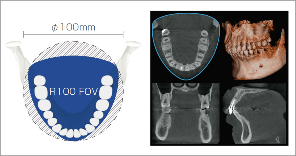 歯列弓型のFOVを採用することで被曝線量が20％低減される。