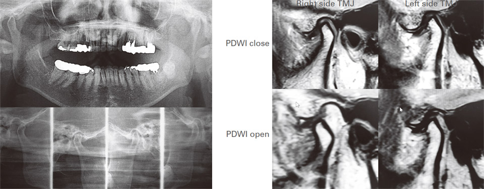 症例1。MRI上で両側顎関節に非復位性関節円板前方転位と下顎頭の骨変形を認める。