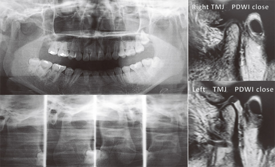 症例2。Squire mandibleを呈するが、MRIでは顎関節部に異常所見を認めない。
