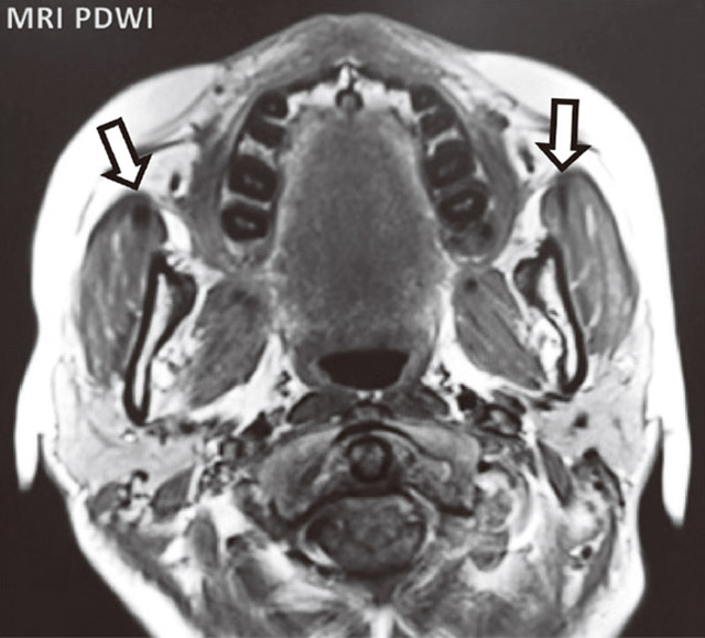 MRI水平断。両側咬筋の前縁部、筋腹に繊維化を示唆する筋状の低信号領域を認める（矢印）。