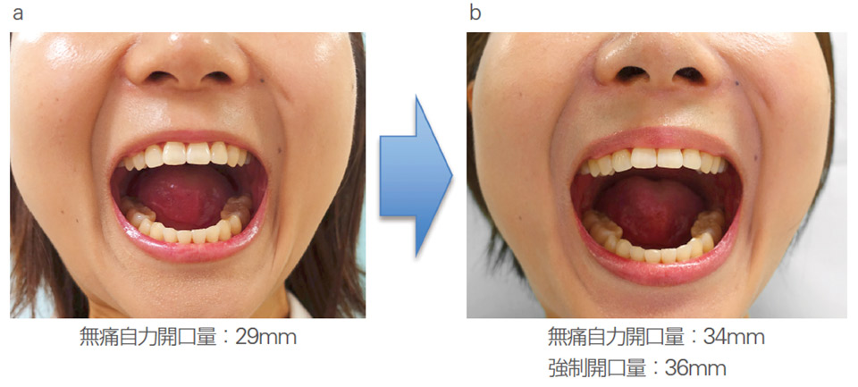 図8 a : 無痛自力開口量は29mmにて新型開口訓練器の使用を開始した。b : 使用開始3ヵ月で無痛自力開口量34mm、強制開口量36mmまで改善した。