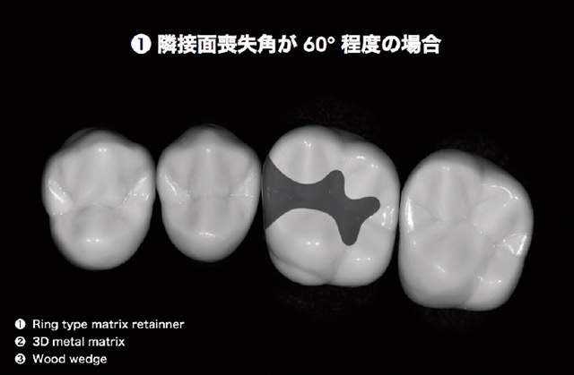 頰舌側隅角部歯質をある程度温存して窩洞形成を完了