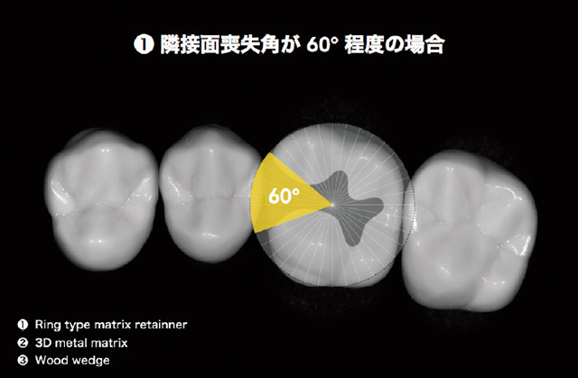 窩洞形成後の隣接面喪失角が60°程度の場合