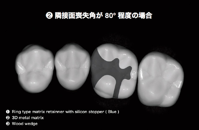 頰舌側隅角部歯質を僅かに温存して窩洞形成を完了