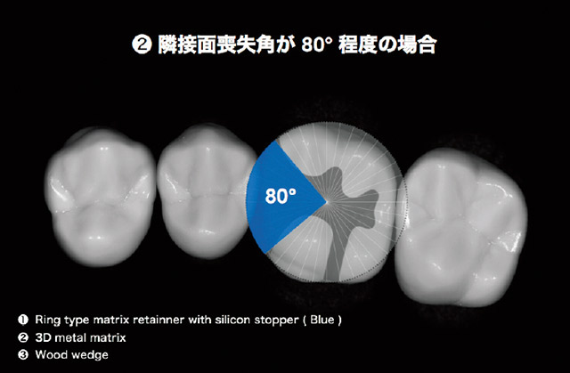 窩洞形成後の隣接面喪失角が80°程度の場