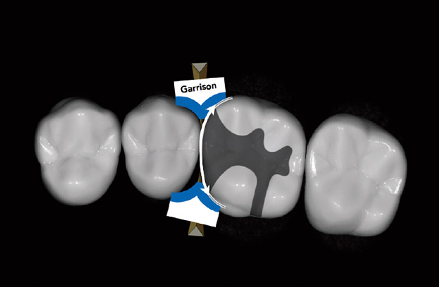 コンポジタイト3Dリテーナー（フュージョンS）の設置が適応