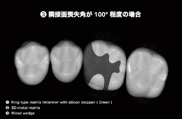 頰舌側隅角部歯質を止むを得ず削除して窩洞形成を完了