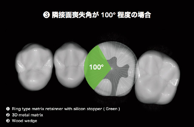 窩洞形成後の隣接面喪失角が100°程度の場合