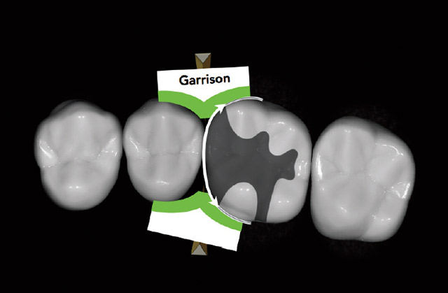 コンポジタイト3Dリテーナー（フュージョンL）の設置が適応