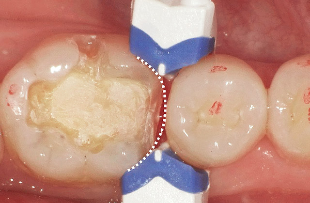 コンポジタイト3Dリテーナー（フュージョンS）を設置するも、形態不適合で変更に