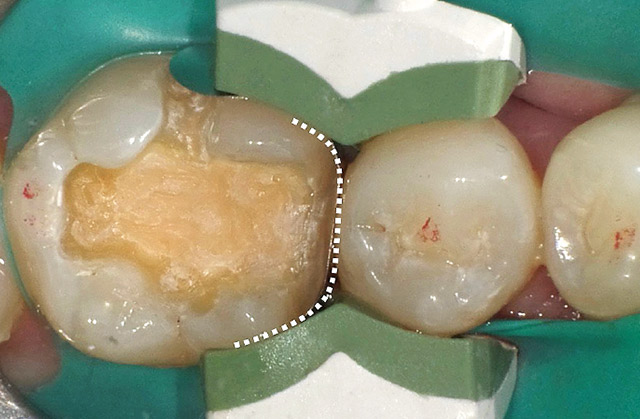 コンポジタイト3Dリテーナー（フュージョンL）を設置