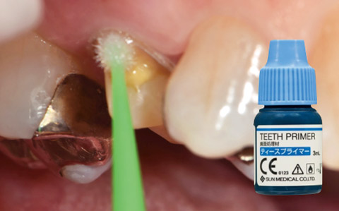 支台歯の歯牙の部分にはティースプライマーを塗布して20秒間待ち、その後乾燥させる。