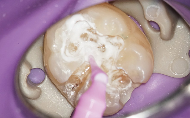 窩洞形成後にティースメイトディセンシタイザー（クラレノリタケデンタル）を用いて象牙質の保護を行う（ミラー像）。