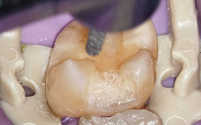2度目の来院時に患歯の治療を再開する。前回象牙質の表面に充填してあるレジンの表層を削合し未反応官能基とフィラーが露出する状態を作る。