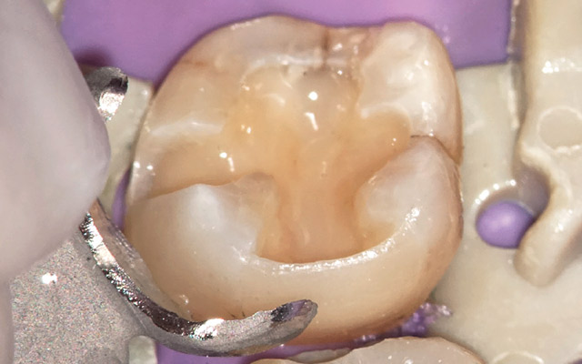 キャストマトリックスを用いることで隣接面の歯頸部、コンタクトポイント、辺縁隆線に到るまでのエリアを一塊として、解剖学的な形態を考慮して回復できる。