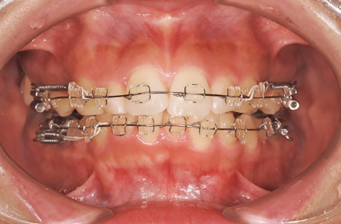 矯正治療中の患者の口腔内。