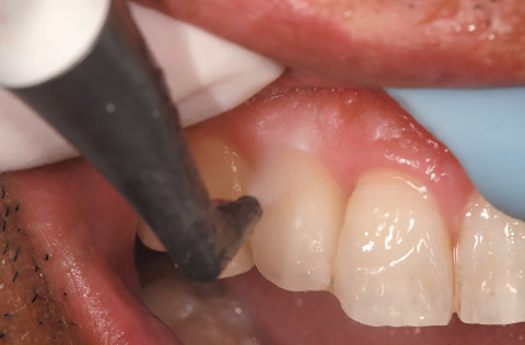 図17 歯頸部清掃中の様子。