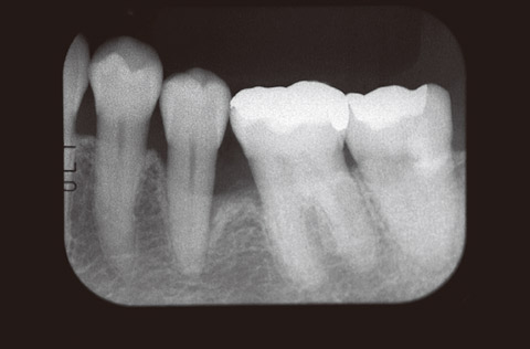 図21 歯周治療中のX線写真