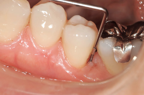 図22 図21の口腔内。プロービング値6〜7mm。