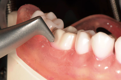 図8 ノズルの当て方を模型上にて解説。歯肉溝とノズル先端には30〜60°の角度をつけ、歯肉溝から3〜5mm離した状態で清掃する。
