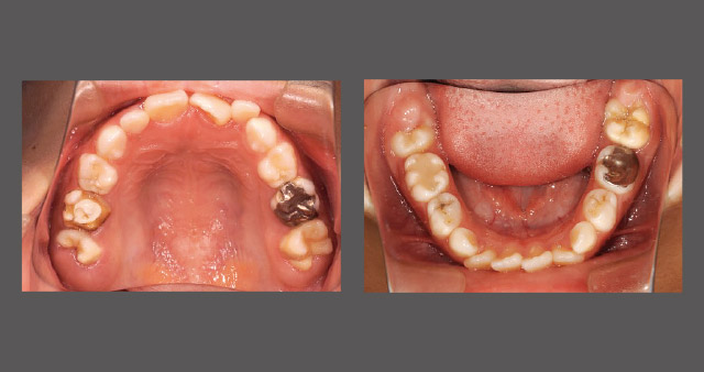 エナメル質形成不全症の症例（7歳、男児）