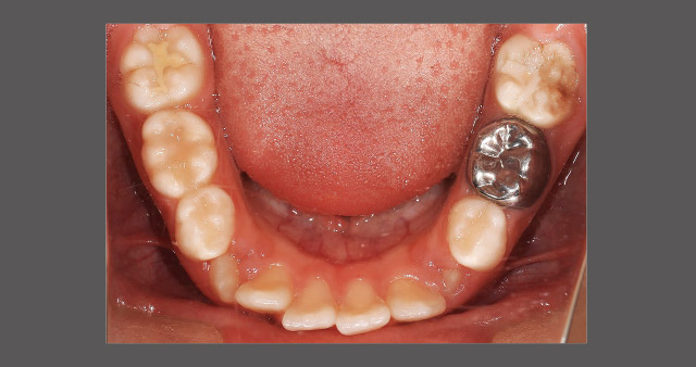 萌出した下顎第一大臼歯にエナメル質形成不全の写真