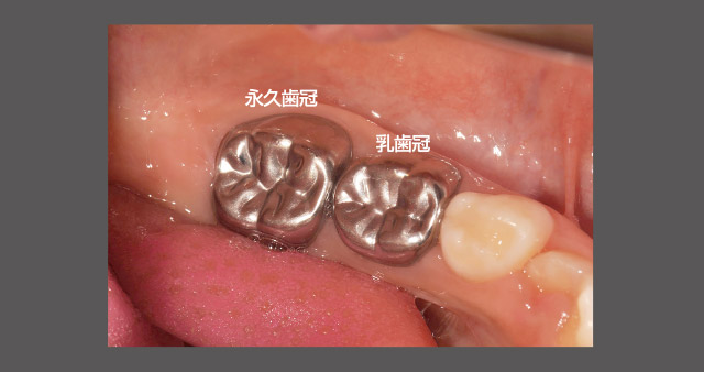 装着したパーマクラウン（第一大臼歯）の写真