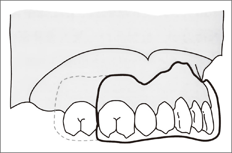 図10 マウスガードの外形線（側面観・要説スポーツ歯科医学より引用）。