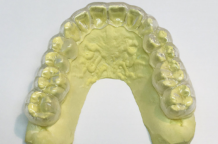 図19 咬合調整・研磨が終了したマウスガード（咬合面観）。
