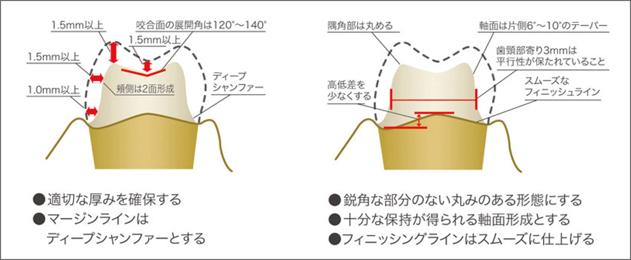 図9 クラウン形成厚み、注意点