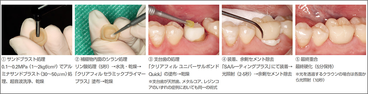 図11 臨床における接着術式