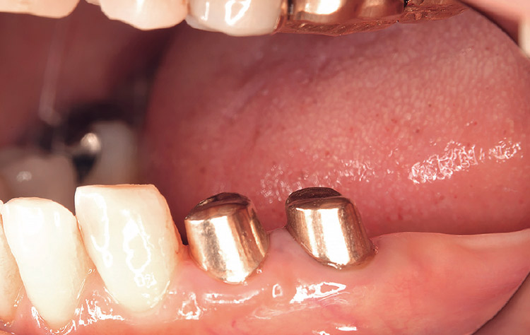 図9 コーヌス義歯支台歯。孤立歯と同じように歯面を1周磨く必要がある。