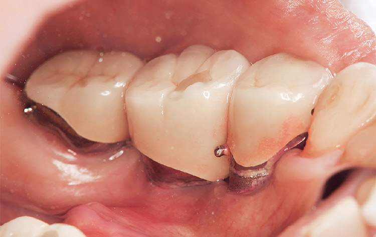図11 インプラント部舌側。隣接面・歯頸部にプラークが残っている。（ミラー像）