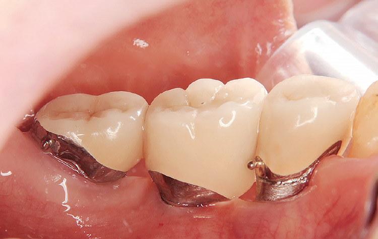 図12 プラークがしっかりと除去されている。（ミラー像）