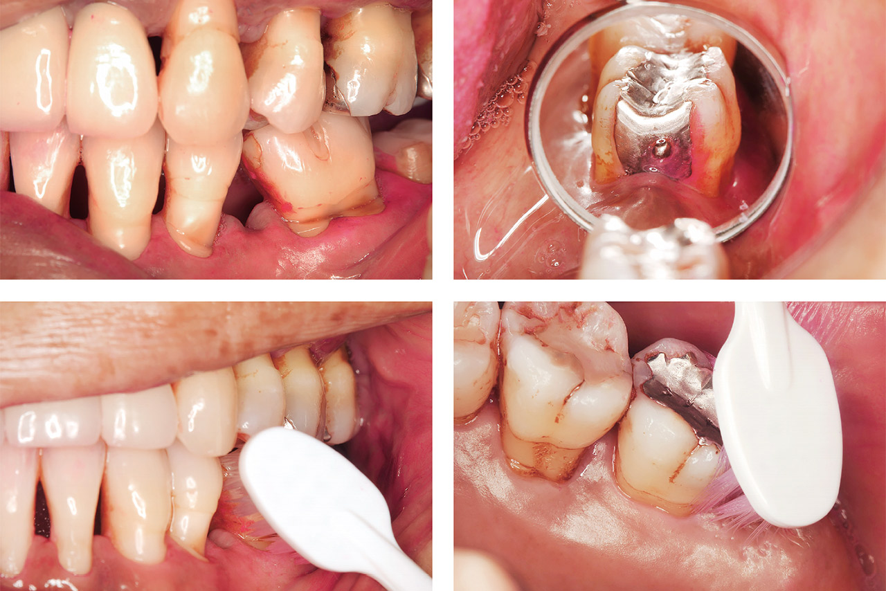 図14 歯間部、最後臼歯遠心にプラーク残存が見られる。