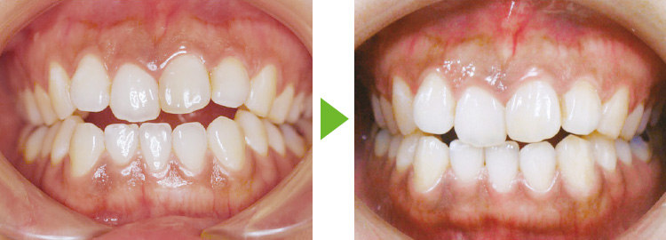 ガム咀嚼による開咬の改善例の写真