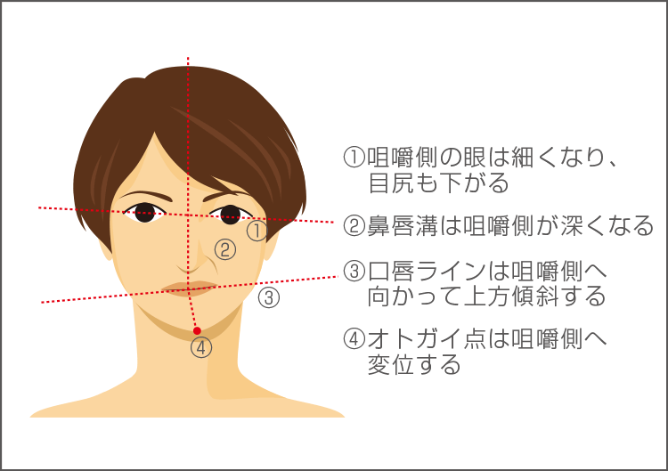 偏咀嚼癖による顔貌の歪みの図