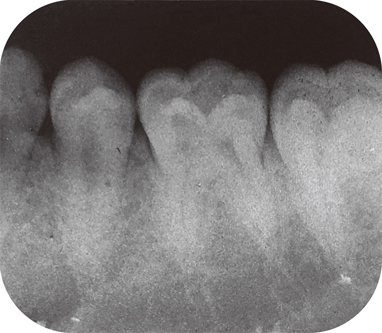 図2 X線画像でのう蝕診査。比較的小規模なう蝕では明確な透過像は確認できない。